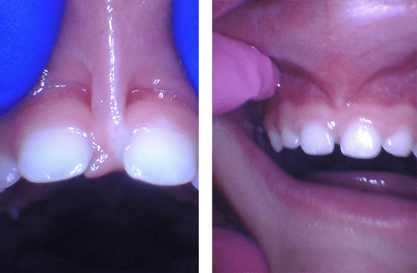 toddlerliptie Shelby Pediatric Dentistry Serving The