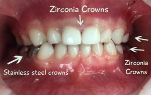 Zirconia-vs-Silver Shelby Pediatric Dentistry