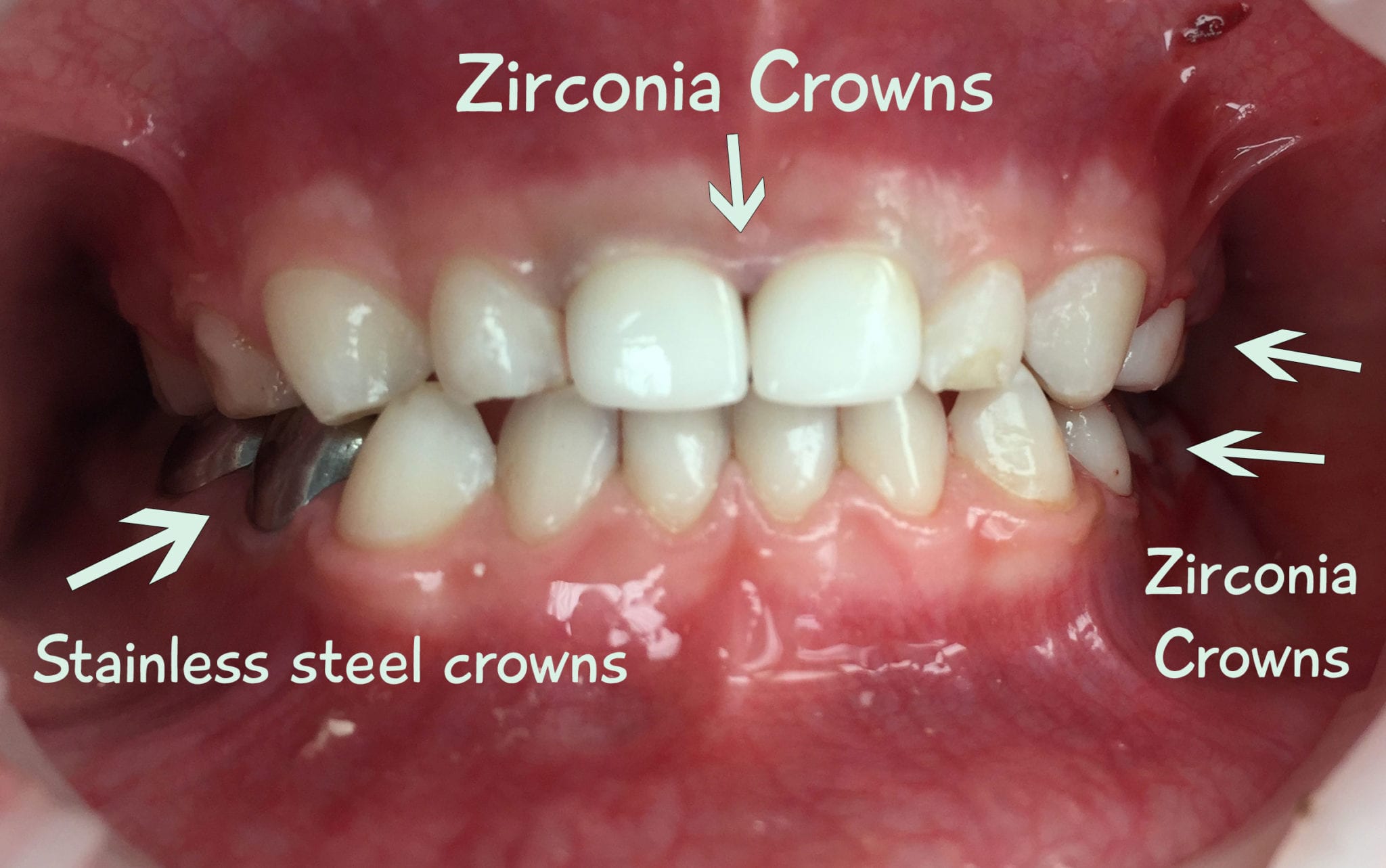 Several Methods of Teeth Repair