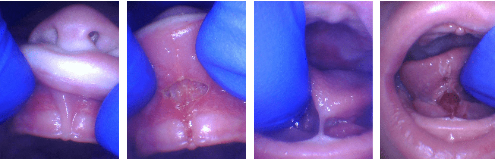 The Tongue-Tie Will Stretch Out And Other Common Myths, Part 2. - Alabama  Tongue-Tie Center, Dr. Baxter & Dr. Trego