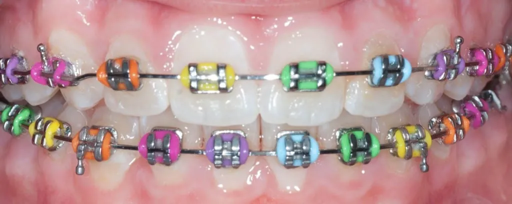 Braces Shelby Pediatric Dentistry Braces Shelby Pediatric Dentistry