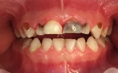 FAQ: How Does My Child Get Cavities?