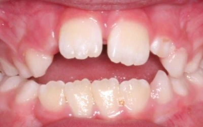 FAQ: Is it ok if my child still sucks their thumb or pacifier?