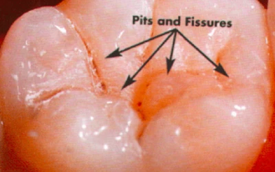 FAQ: What are sealants?