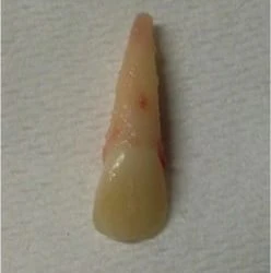 FAQ: What should I do if my child knocks out his permanent tooth?